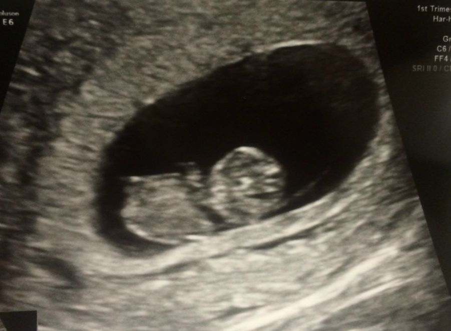 Wrestling With The Fear of Miscarriage In The First 12 Weeks - Sonogram